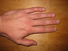 Arthrosefinger