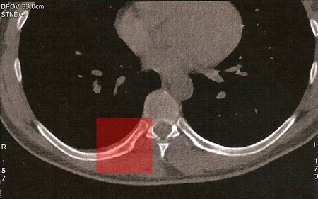 CT1