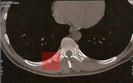 CT2