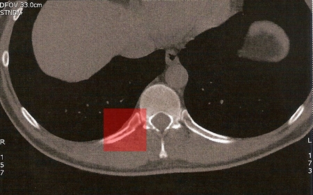 CT3